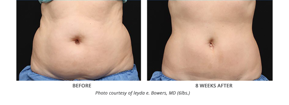 Coolsculpting Before and After