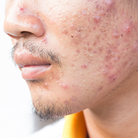 acne treatment in delaware county pa