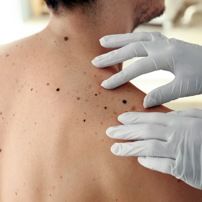 skin cancer screening in delaware county