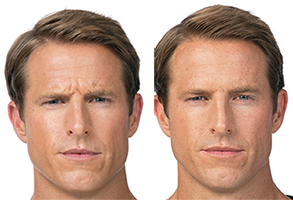 Botox for men at Brinton lake Dermatology in Glen Mills PA