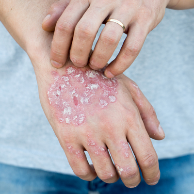 psoriasis treatment in glen mills pa