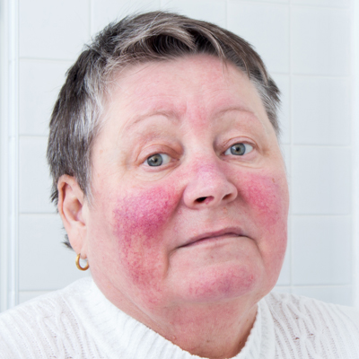 rosacea treatment in glen mills pa