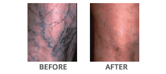 Sclerotherapy Treatment Before and After Glen Mills PA