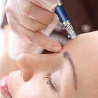 microneedling treatment in glen mills pa