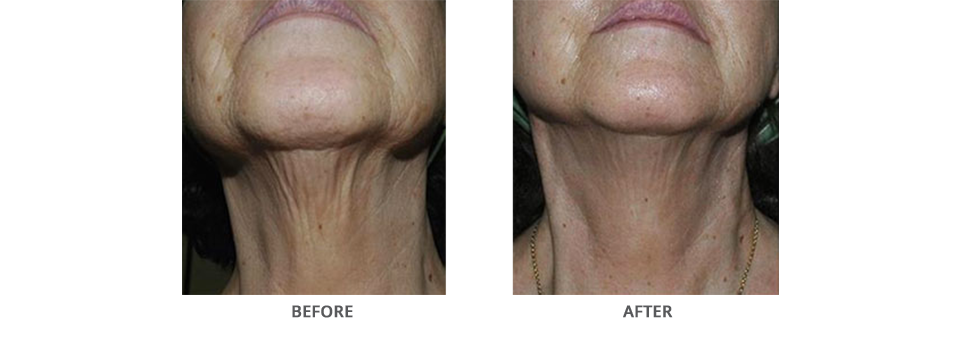 Sublative Before and After