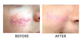 Vbeam Before and After Treatment Delaware County