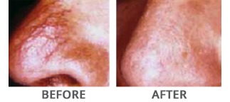 Vbeam Before and After Treatment Glen Mills PA