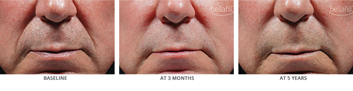 Bellafill Before and After for Nasolabial Lines