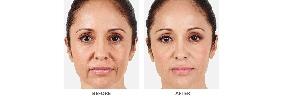 Juvederm Vollure Before and After Glen Mills PA