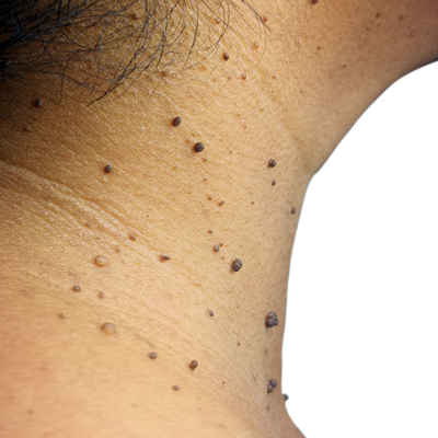 mole examination in glen mills pa