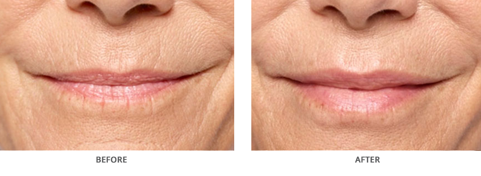 Restylane Silk Before and After Glen Mills PA
